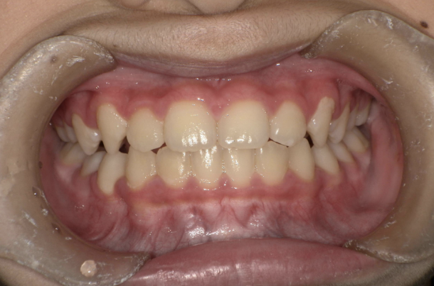 治療後（症例1）