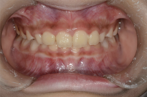 治療後（症例2）