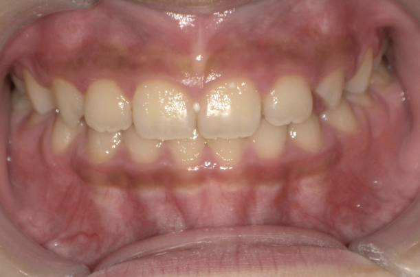 治療後（症例3）