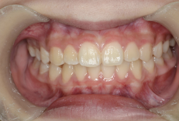 治療後（反対咬合：症例4）