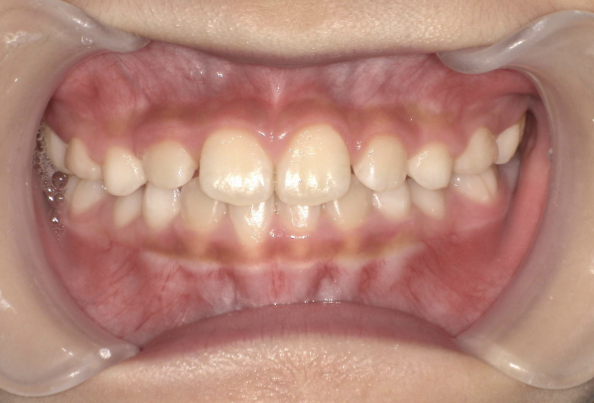治療後（反対咬合：症例5）