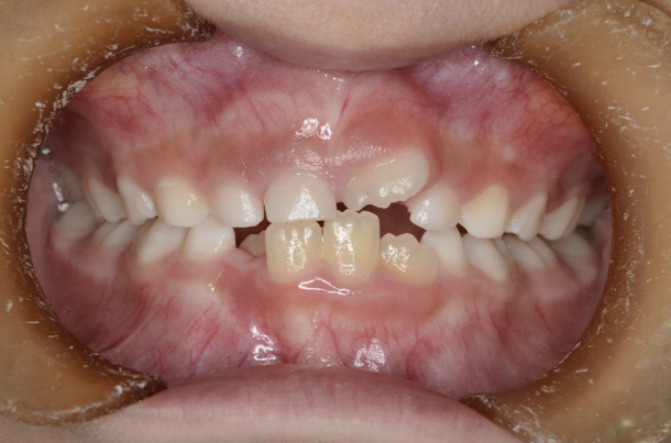 治療前（症例1）