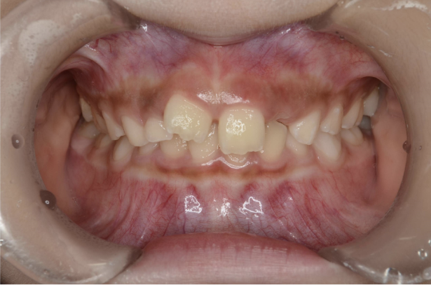 治療前（症例2）