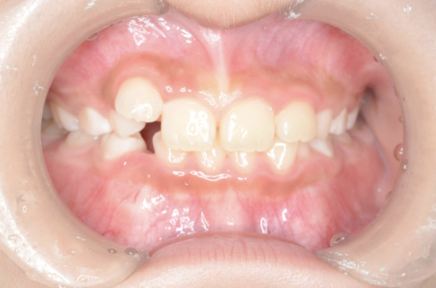 治療前（症例3）