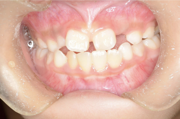 治療前（反対咬合：症例4）