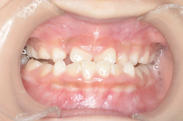 治療前（反対咬合：症例5）
