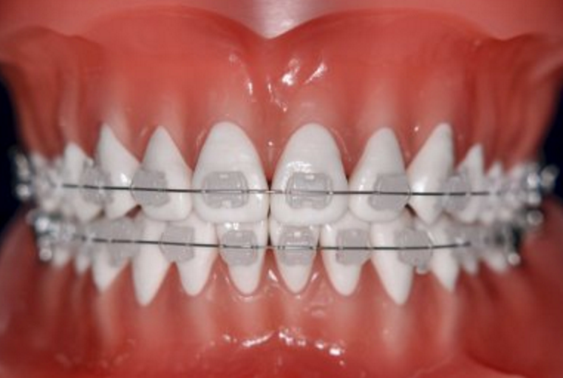 はり金の矯正治療のイメージ